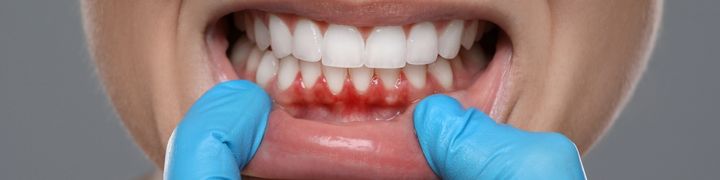 dis-eti-cekilmesi-gorsel