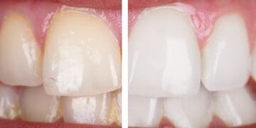 dis-rengi-degisikligi